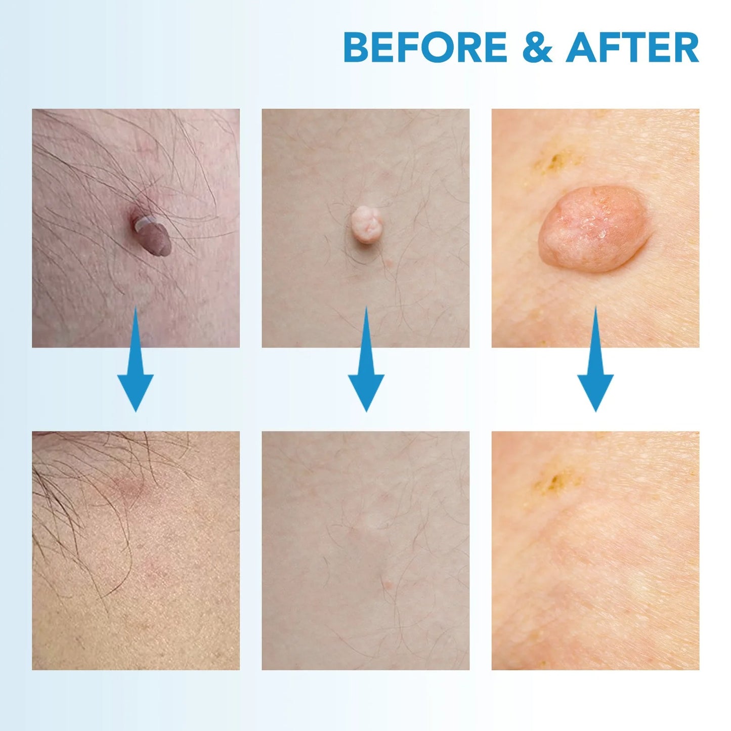Skin Tag Remover Kit