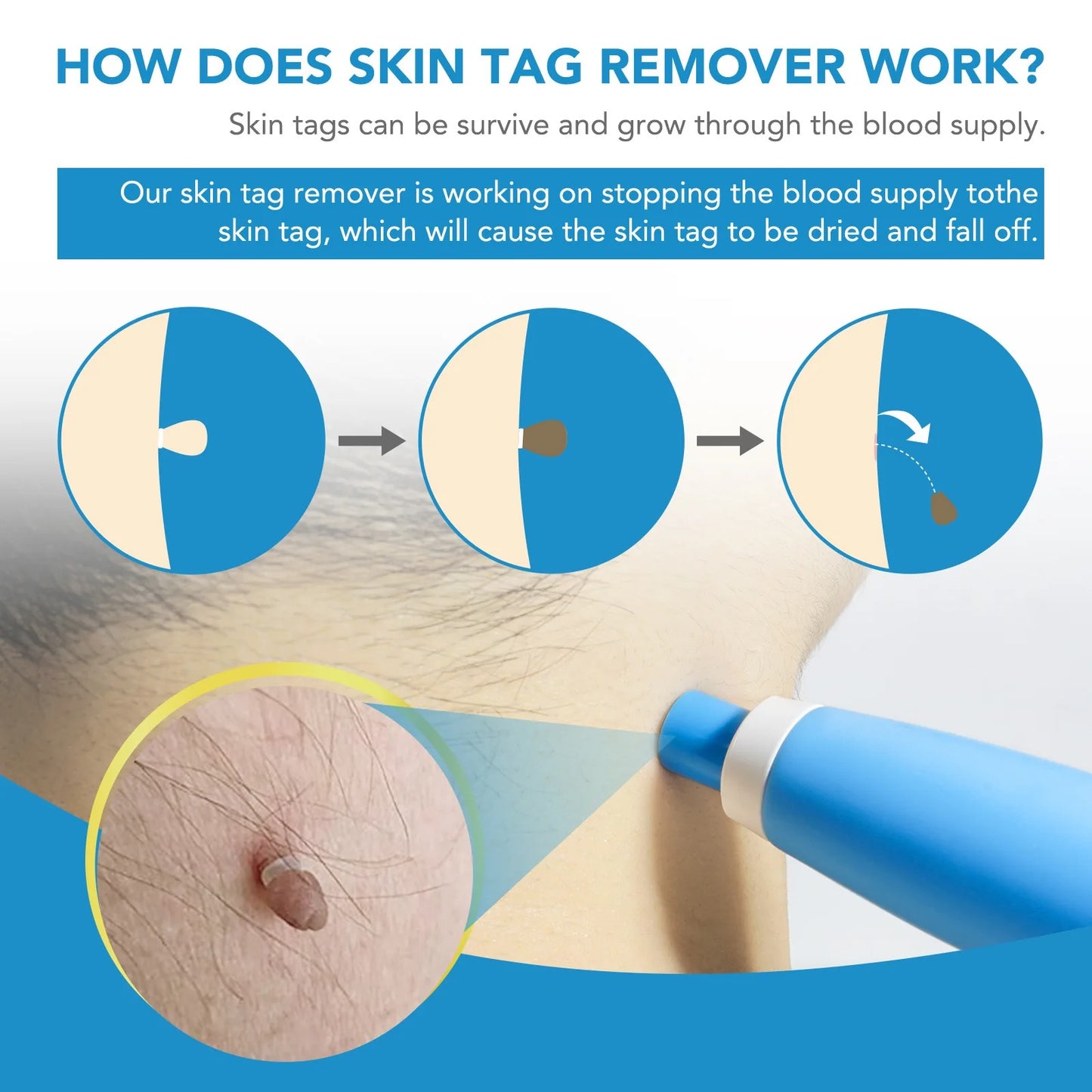 Skin Tag Remover Kit