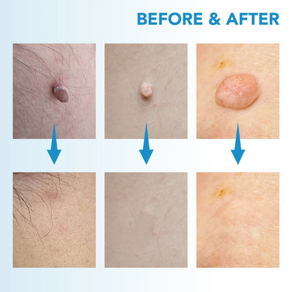 Skin Tag Remover Kit